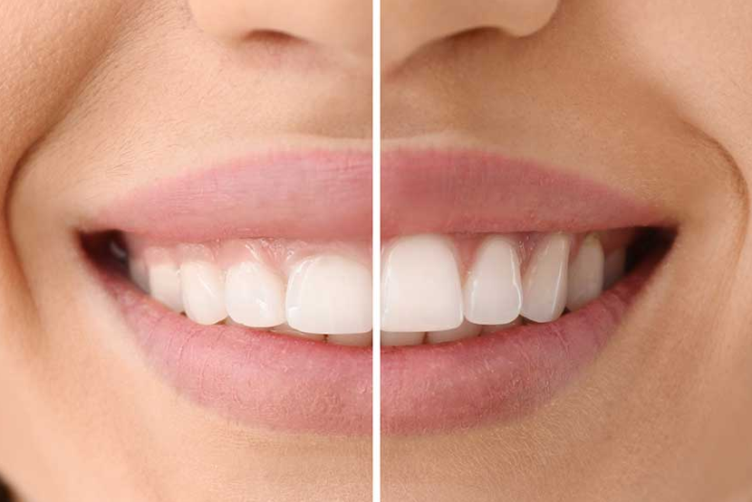 Diş Eti Estetiği (Gummy Smile)