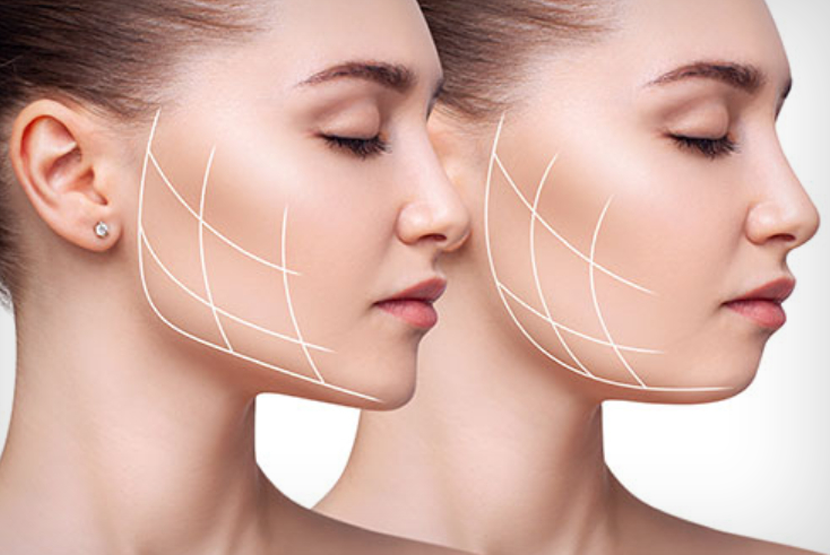 Masseter Botoksu
