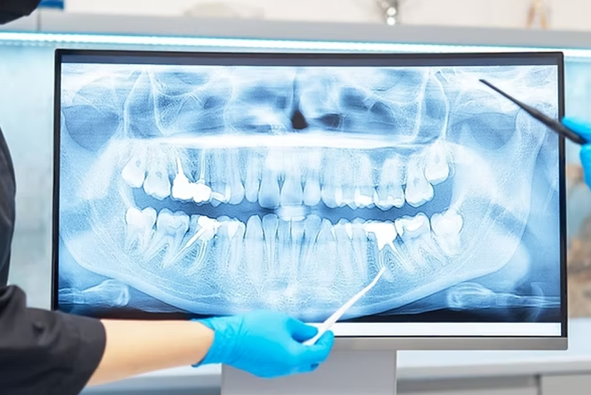 Dijital Diş Röntgeni (Dental Radyoloji)