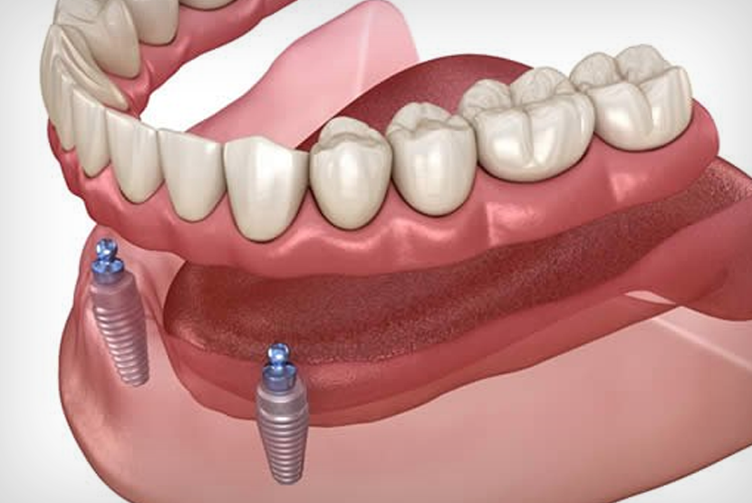 İmplant Destekli Hareketli Protez (Overdenture)