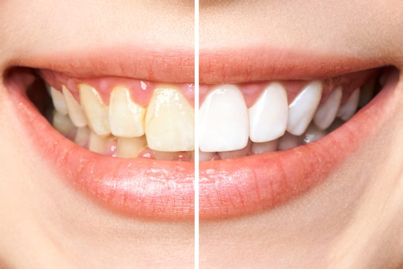 Diş Beyazlatma (Bleaching)
