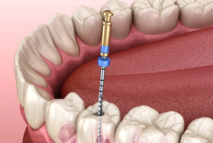 Kanal Tedavisi (Endodonti)