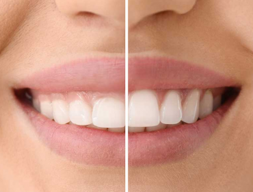 Diş Eti Estetiği (Gummy Smile)