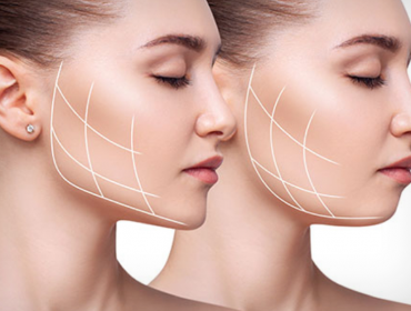 Masseter Botoksu
