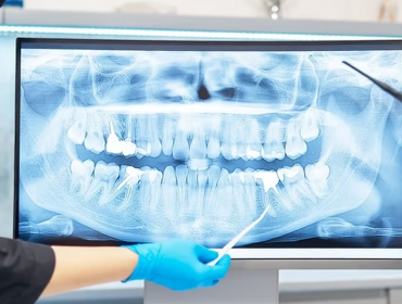 Dijital Diş Röntgeni (Dental Radyoloji)