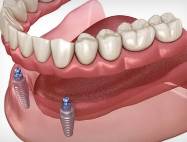 İmplant Destekli Hareketli Protez (Overdenture)