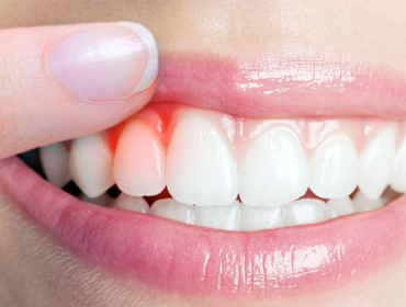 Diş Eti Hastalıkları Tedavisi (Periodontal Tedavi)