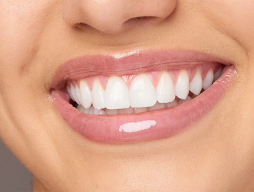 Hollywood Smile (Gülüş Tasarımı)