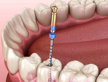 Kanal Tedavisi (Endodonti)